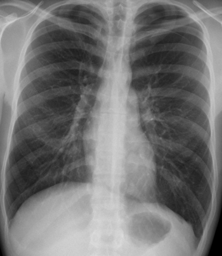 Pneumothorax Undergraduate Diagnostic Imaging Fundamentals