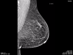 Labeled normal mammograms, Radiology Case