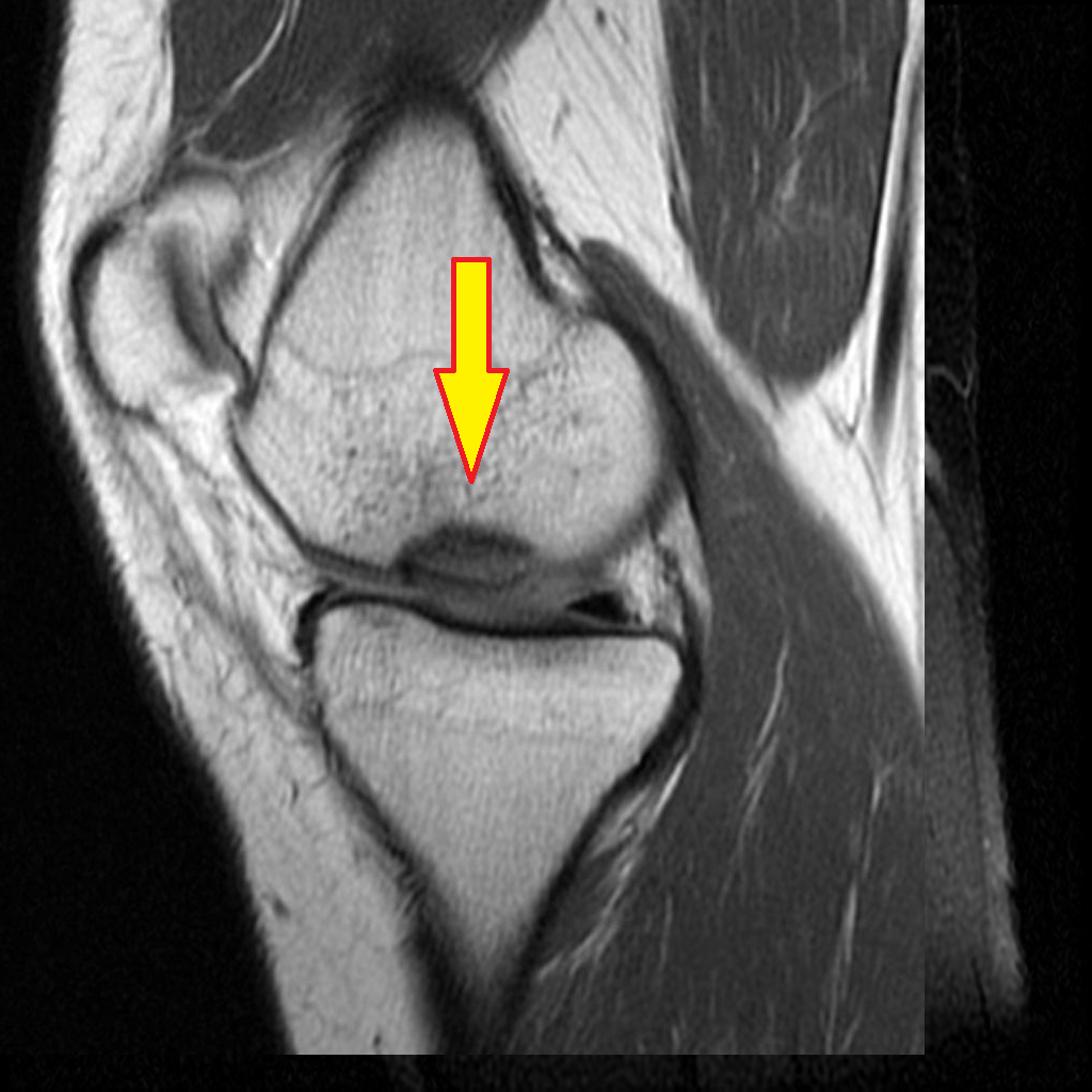 Chondral Injuries Of The Knee Orthopaedia Sports Medicine