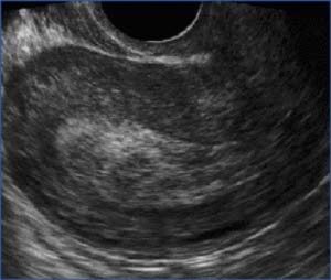 ULTRASOUND AS NEEDED WITH MEDICATION ABORTION – TEACH Abortion Training ...