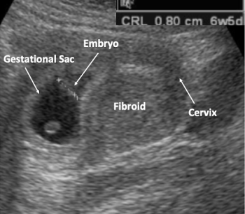 ULTRASOUND FINDINGS WITH ABNORMAL PREGNANCIES – TEACH Abortion Training ...