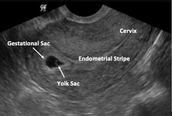 ULTRASOUND (US) OVERVIEW, METHODS, TIPS & IMAGES – TEACH Abortion ...