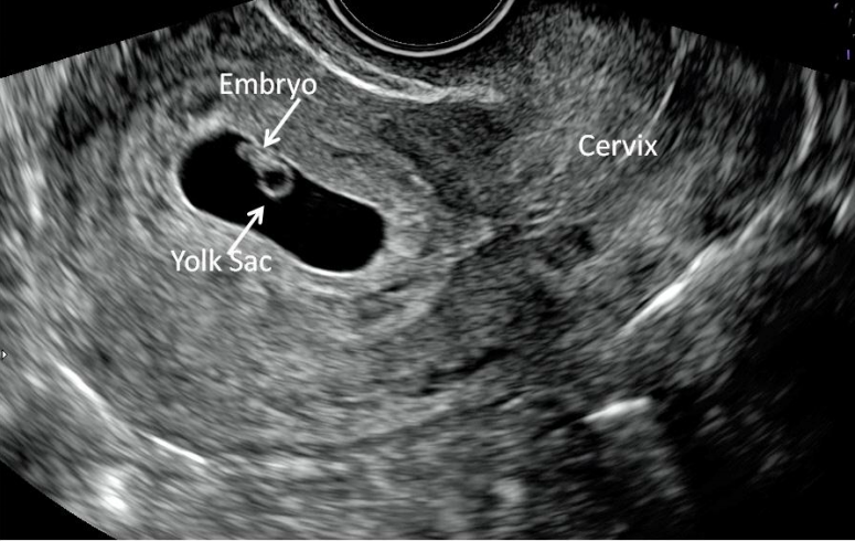 ultrasound longitudinal view