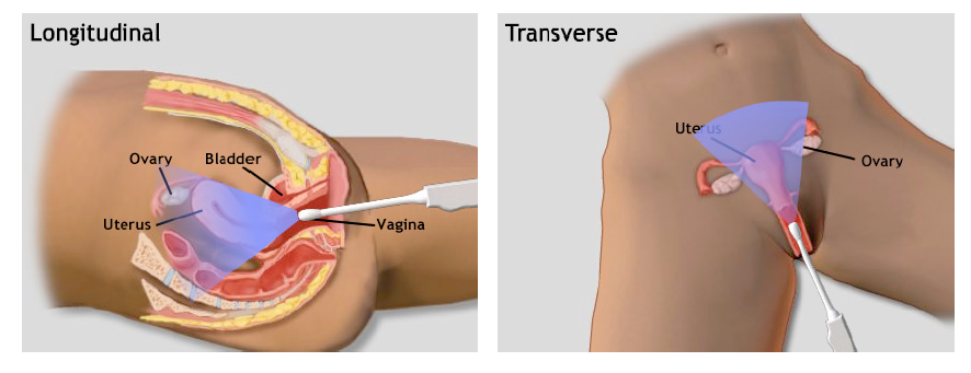 transvaginal_scan_positions_arms_chap4.3