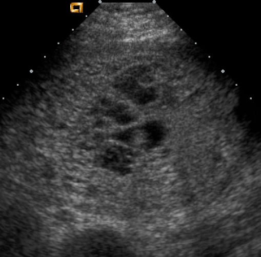 Gestational trophoblastic disease (molar pregnancy)