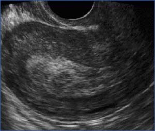 SUCCESSFUL ABORTION