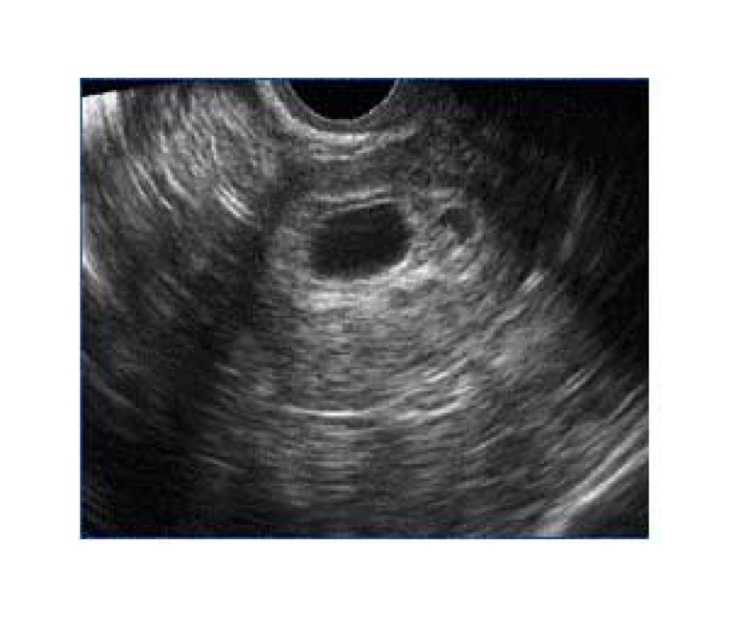 PERSISTENT GESTATIONAL SAC AFTER MEDICATION ABORTION