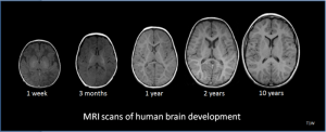 An image showing MRI scans of a brain at ages 1 week, 3 months, 1 year, 2 years, and 10 years.