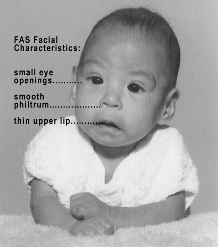Baby with the FAS syndrome.