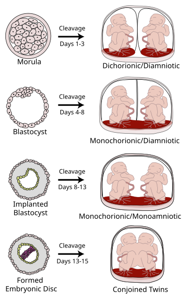 Illustrates various types of chorionicity and amniosity (how the baby's sac looks) in monozygotic (one egg/identical) twins as a result of when the blastocyst or embryo splits.