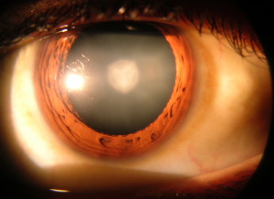 Cataract in human eye