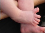 Image of toes curling to demonstrate babinski