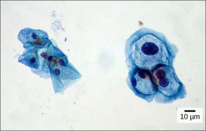 Both normal cells and cells infected with HPV have an irregular, round shape and a well-defined nucleus. Infected cells, however, are two to three times as large as uninfected cells, and some have two nuclei.