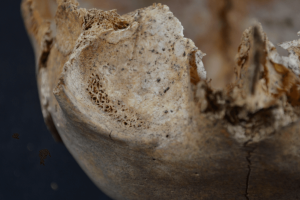 Close-up photo of eye socket, showing small holes in the bone