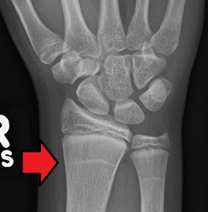 xray image of a wrist, showing thick white lines