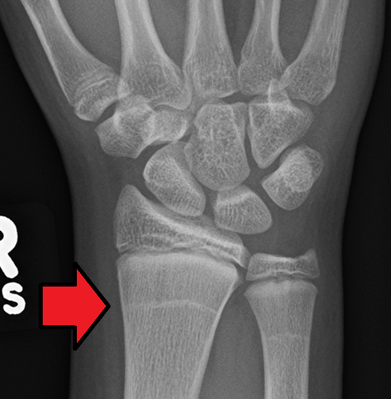 X-ray image of a wrist, showing Harris lines