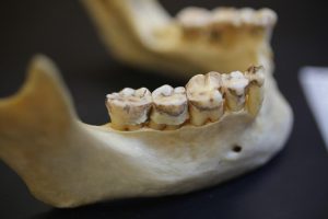 Close-up photo of the lower jaw and back teeth, showing wear on the molars