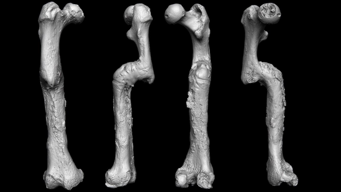 Front, back, and side views of a severely fractured femur, which healed at an angle.