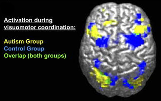 image of a brain scan with sections in different colour and each section is labeled