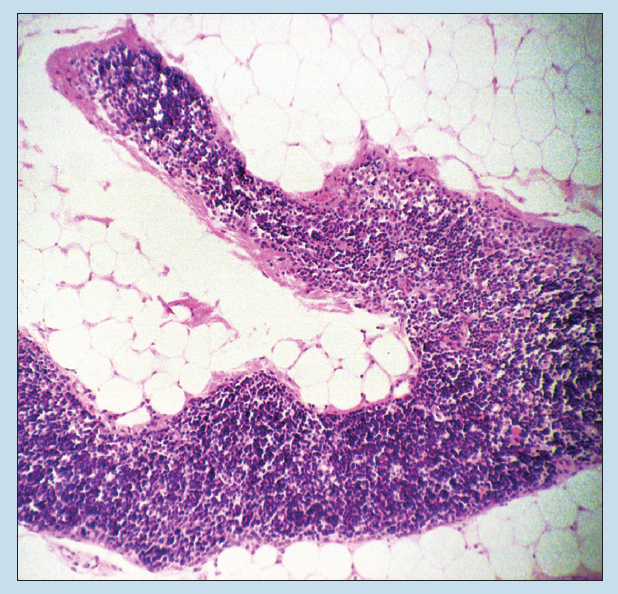 Figure 11-12 is a slide image of atrophic thymus at 25X magnification.
