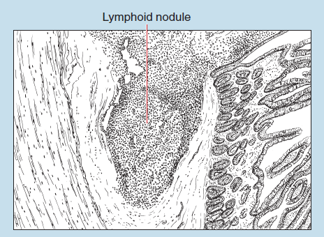 Figure 11-2 slide image (upper) and a sketch image (lower) of aggregated lymphoid nodule at 25X. The sketch is labelled to show lymphoid nodule.