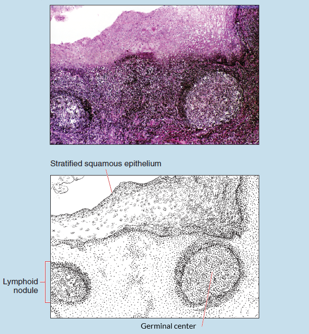 Figure 11-3 slide image (upper) and a sketch image (lower) of palatine tonsil at 25X magnification. The sketch is labelled to show stratified squamous epithelium, lymphoid nodule, and germinal center.