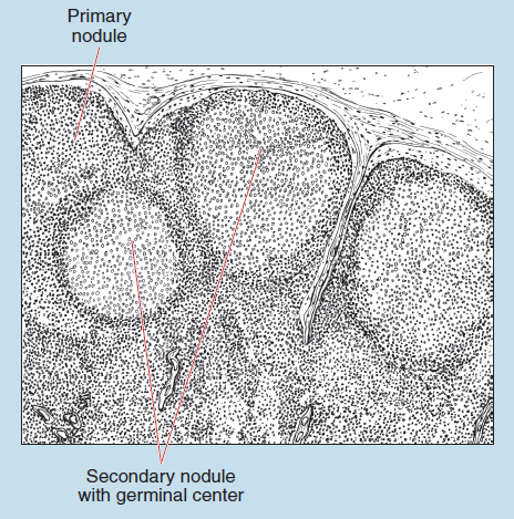 Figure 11-8 slide image (upper) and a sketch image (lower) of lymph node at 25X magnification. The sketch is labelled to show primary nodule and secondary nodule with germinal center.