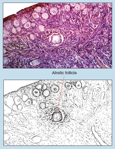 Figure 15-6 is a slide image (upper) and a sketch image (lower) of follicular atresia at 50X magnification. The sketch is labelled to show an atretic follicle.