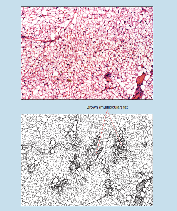 Two representations of brown (multilocular) adipose tissue. The upper image is a microscope slide, the lower is a sketch of the same tissue. The sketch is labelled to show brown (multilocular) fat within the sample.