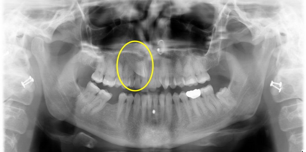 3.2 Orthodontic Interventions – Oral & Maxillofacial Surgery – A ...