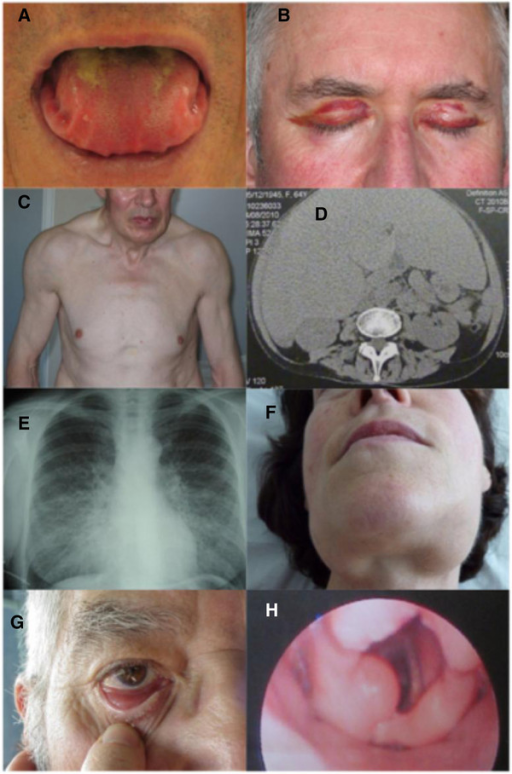 Amyloidose, Amyloid Avleiringssykdom (REV 073) – Grans Kompendium I ...