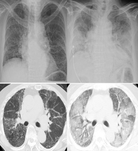 Alvorlig lunge-manifestasjon (Røntgen og CT) ved innleggelse til høyre og utskrivning til venstre hos en 72 år gammel kvinne med antisyntetase syndrom.