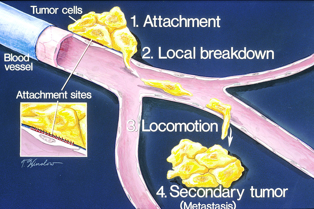 The stages of metastasis are: 1) attachment 2) local breakdown 3) locomotion 4) secondary tumor.