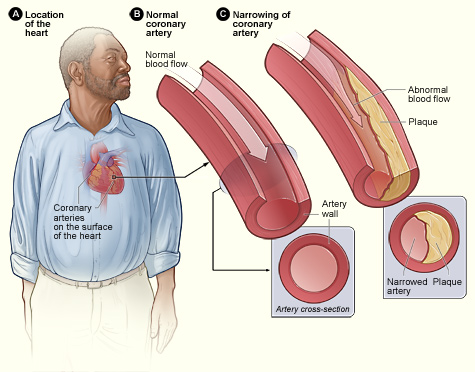 Normally, blood flows freely through the blood vessel. Plaque build up in the blood vessel restricts blood flow.