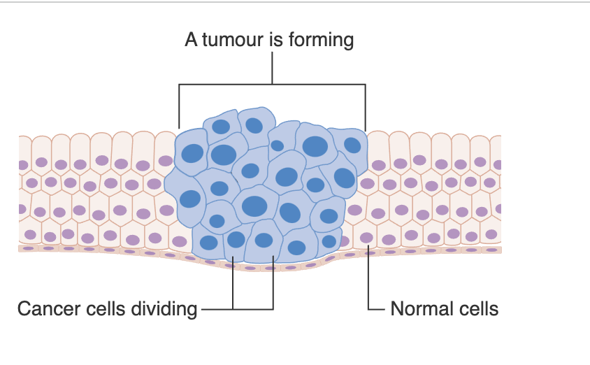 Normal cells stay together. Cancer cells develop into a tumor that is rapidly growing and invading other cells. Cancer cells break through a membrane and spread to other parts of the body.