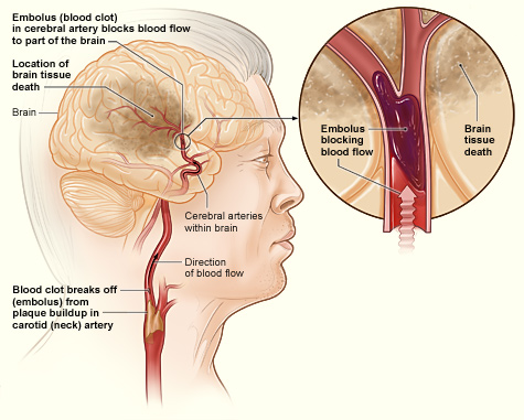The illustration shows how an ischemic stroke can occur in the brain. If a blood clot breaks away from plaque buildup in a carotid (neck) artery, it can travel to and lodge in an artery in the brain. The clot can block blood flow to part of the brain, causing brain tissue death.