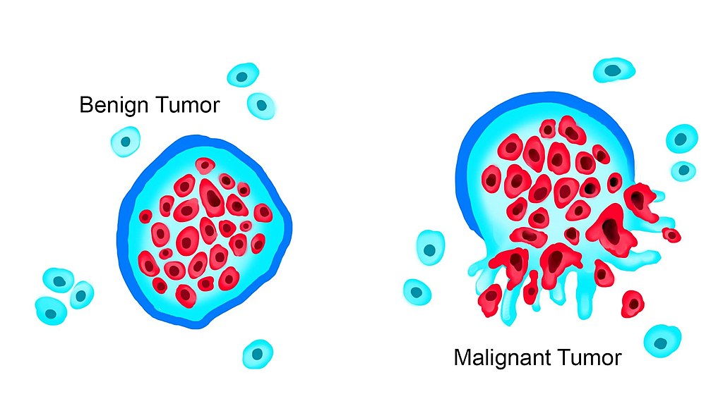 Benign tumor is enclosed in a membrane. Malignant tumor cells leave the primary tumor