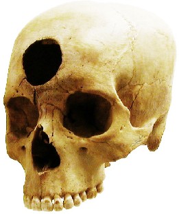 A skull has a large hole bored through the forehead.