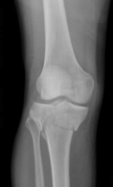 Knee Trauma – Acute Fractures – Undergraduate Diagnostic Imaging ...