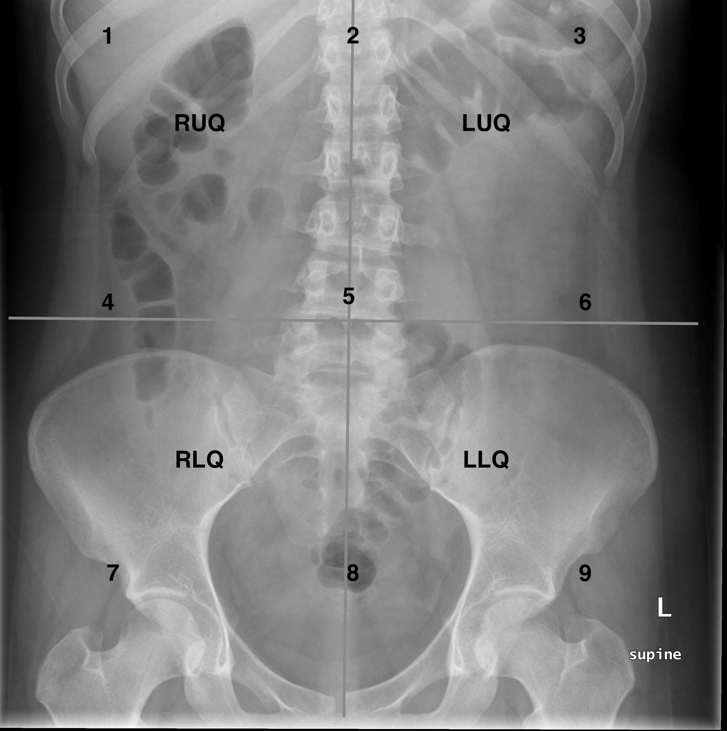 normal abdominal x ray