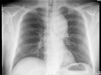 Aortic Dissection and Aneurysm – Undergraduate Diagnostic Imaging ...