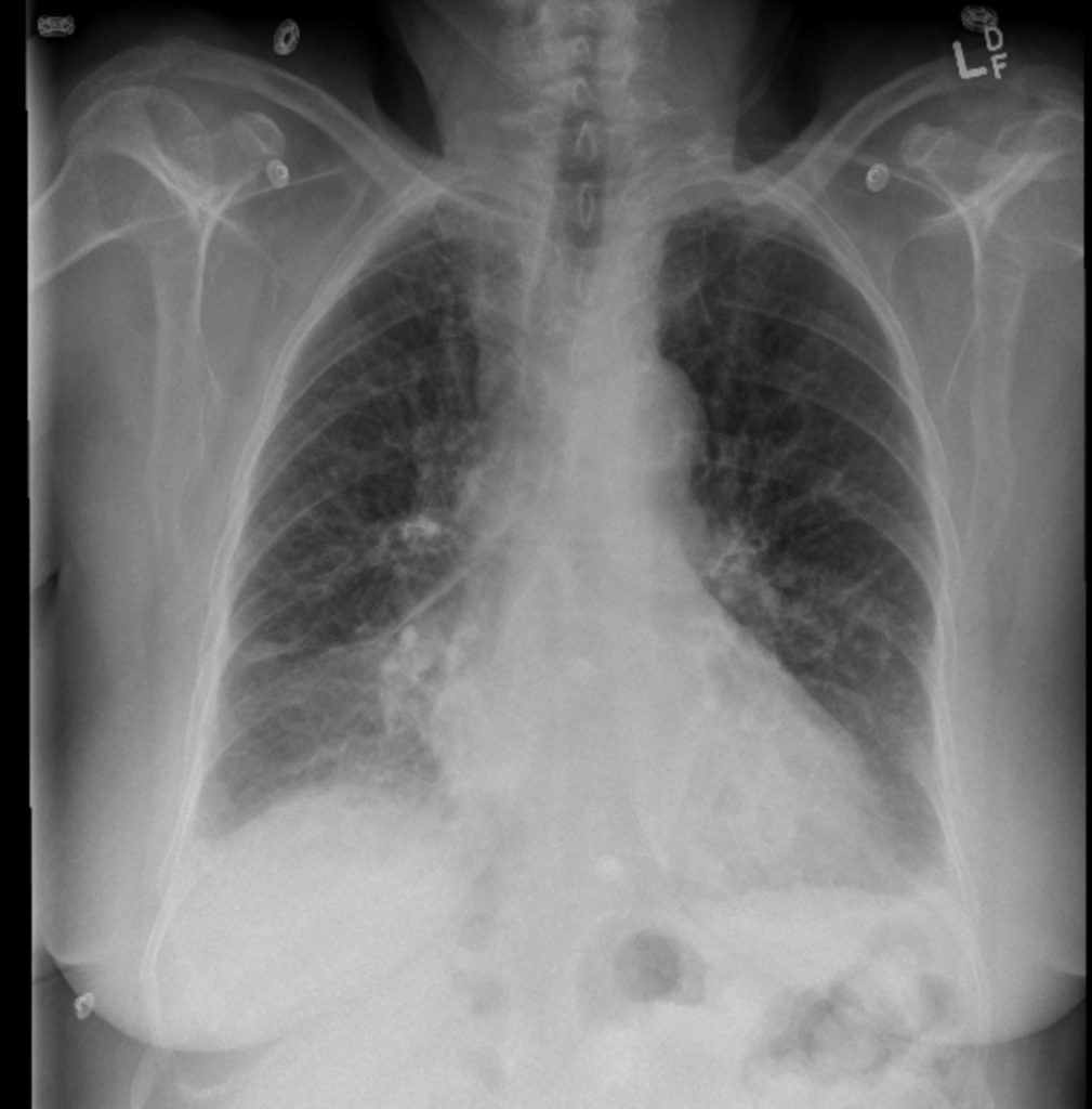 congestive-heart-failure-undergraduate-diagnostic-imaging-fundamentals