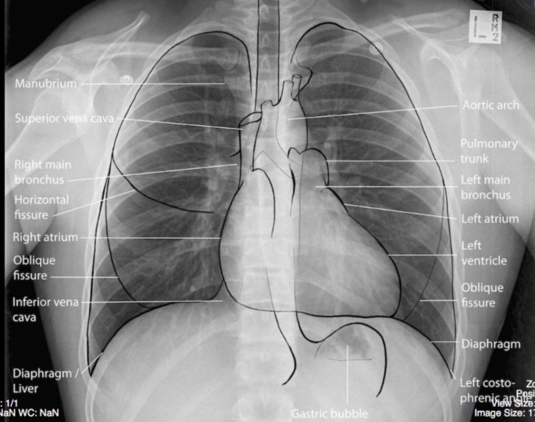 Normal, Labelled, Chest x-ray – Undergraduate Diagnostic Imaging ...