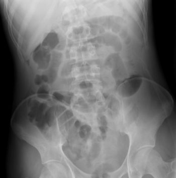 Intestinal Perforation- Pneumoperitoneum – Undergraduate Diagnostic ...