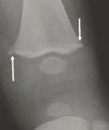 Non-Accidental and Accidental Trauma – Undergraduate Diagnostic Imaging ...