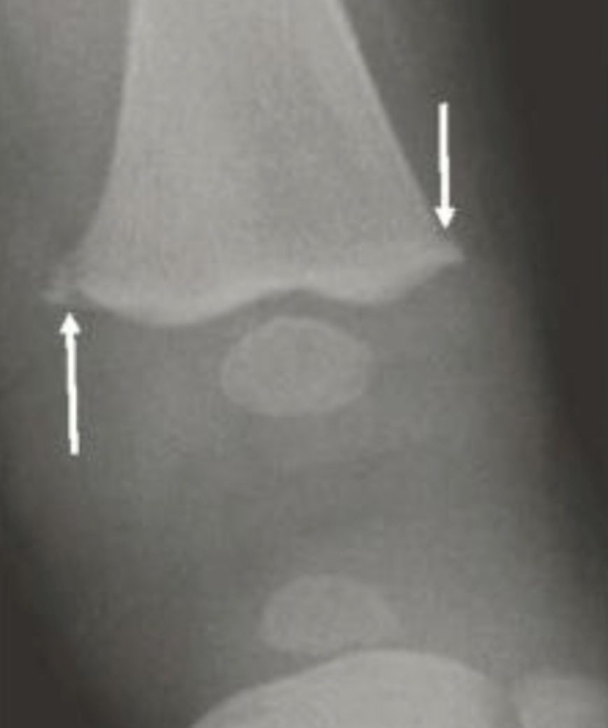 non-accidental-and-accidental-trauma-undergraduate-diagnostic-imaging