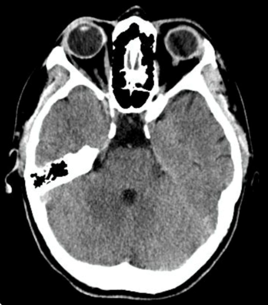 case study on hydrocephalus slideshare