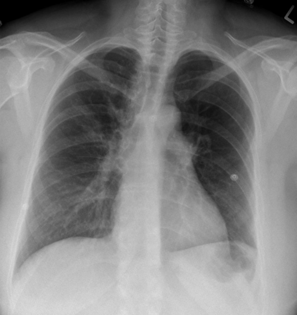 Pulmonary Embolism Chest X Ray | Hot Sex Picture