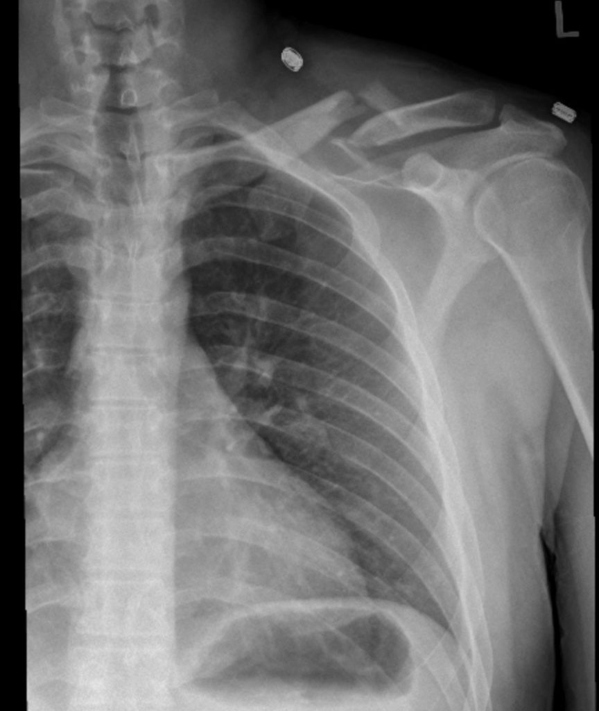 normal clavicle xray