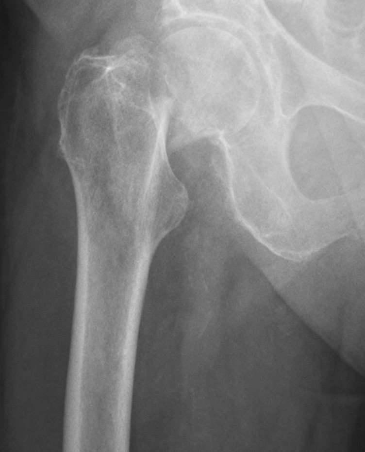 femoral neck fracture